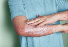 Éviter les erreurs courantes liées au psoriasis pour une meilleure santé de la peau