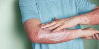 Avoiding Common Psoriasis Mistakes for Better Skin Health