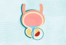 Prostate Cancer: A Comprehensive Overview of Symptoms, Diagnosis, and Treatment