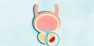 Prostate Cancer: A Comprehensive Overview of Symptoms, Diagnosis, and Treatment